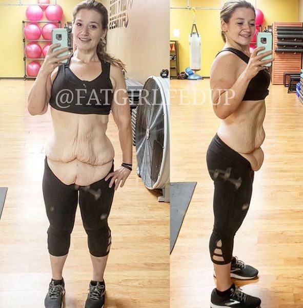 www.instagram.com/fatgirlfedup Nadmiar skóry, ważący 3 kg, usunięto operacyjnie