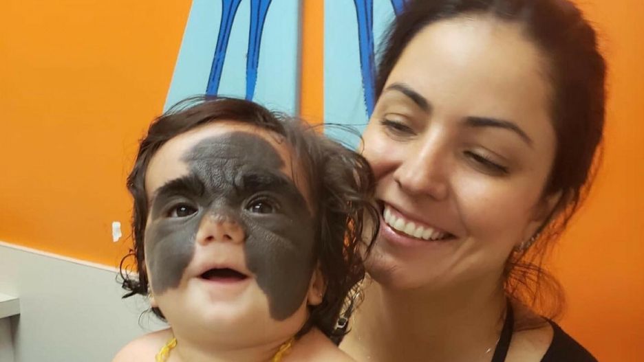 Dziewczynka wyglądała jak Batman. Przeszła pionierską operację, teraz walczy z powikłaniami