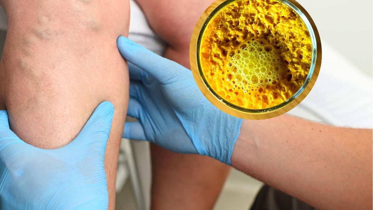 Przyprawy mogą wspomóc dietę antyzakrzepową. Pomagają w walce z wysokim cholesterolem i nadciśnieniem