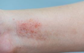 Czym jest atopowe zapalenie skóry?
