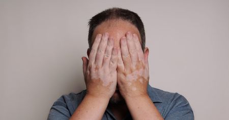 Bielactwo nabyte - przyczyny, objawy, rodzaje, diagnostyka, leczenie