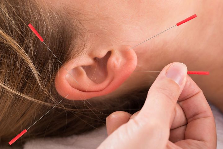 Leczenie akupunkturą stosuje się m.in. w medycynie sportowej