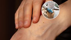 Charakterystyczna zmiana na skórze. Sygnał, że rak zajął jelito grube