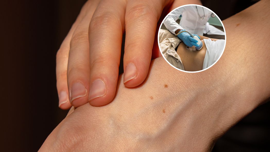 Nietypowe objawy raka jelita. Widać je na skórze