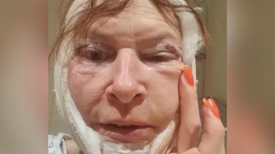 Po nieudanym zabiegu zostały bolesne blizny