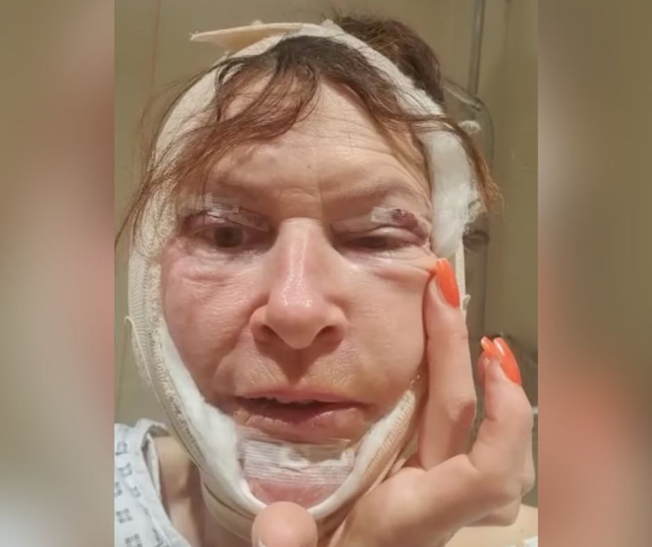 54-latka chciała się odmłodzić. Gorzko żałuje tego zabiegu