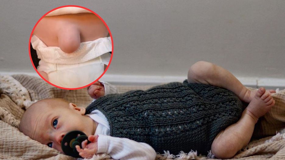 Chłopiec ma na brzuchu charakterystyczny guz