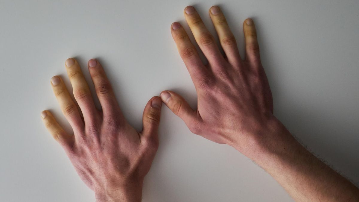 Zespół CREST to jedna z postaci układowego zapalenia tkanki łącznej.