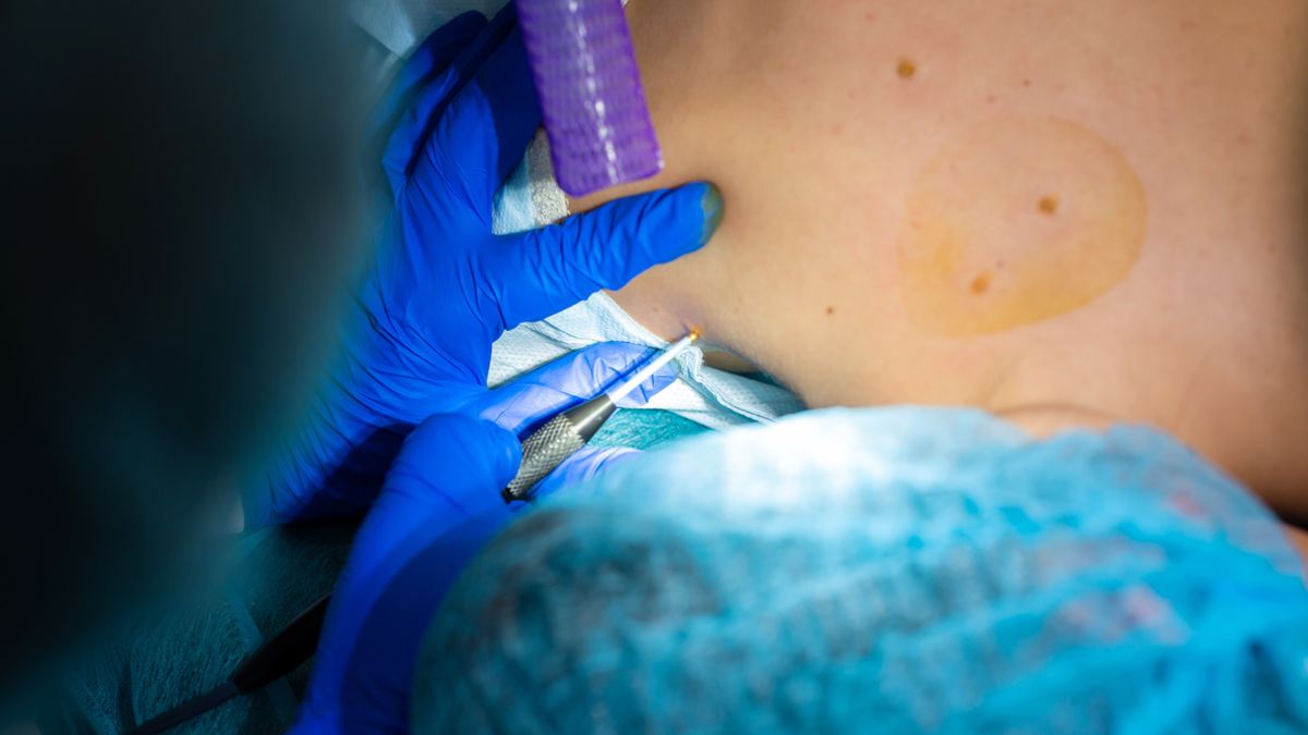 Biopsja  skóry przeprowadzana jest z wykorzystaniem sterylnych narzędzi