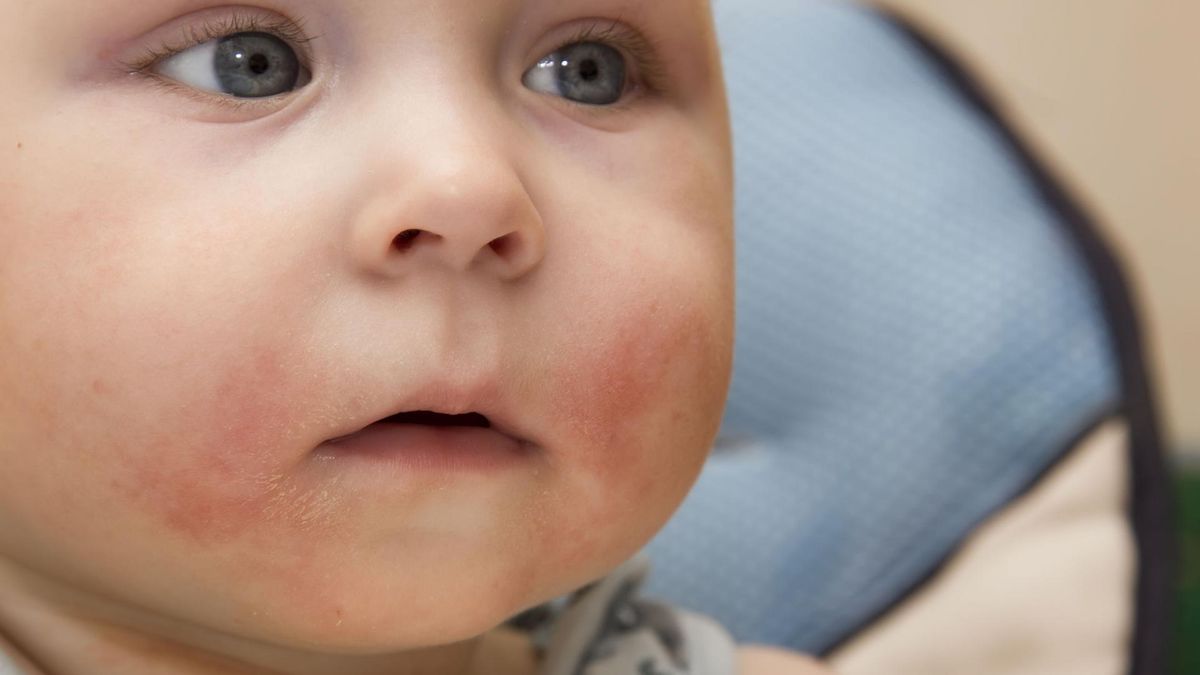 Alergia na gluten u niemowląt