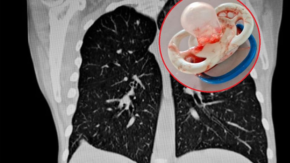 Smoczek utknął w tchawicy