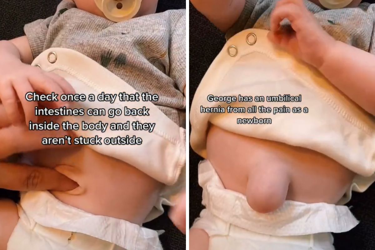 Chłopiec ma przepuklinę pępkową