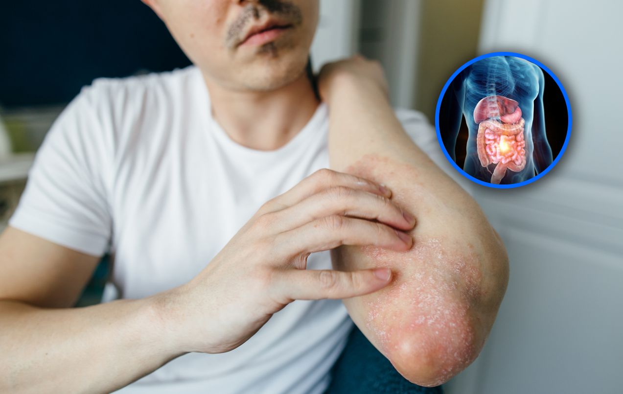 Sygnalizuje choroby jelit, trzustki. Objawy widać na skórze