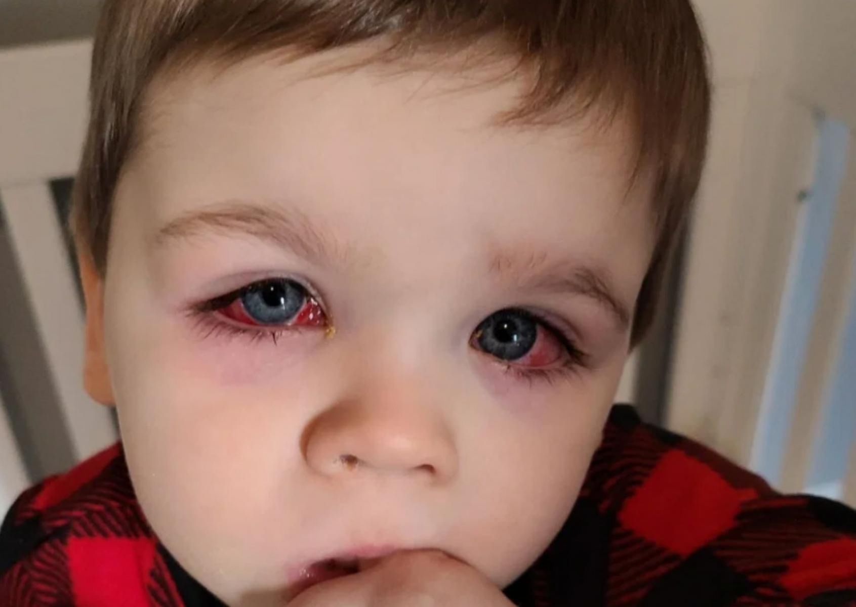 Zakażenie oka wywołane pleśnią