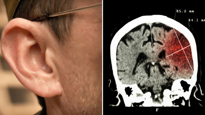 Naukowcy: wystąpienie udaru może zależeć od kształtu ucha