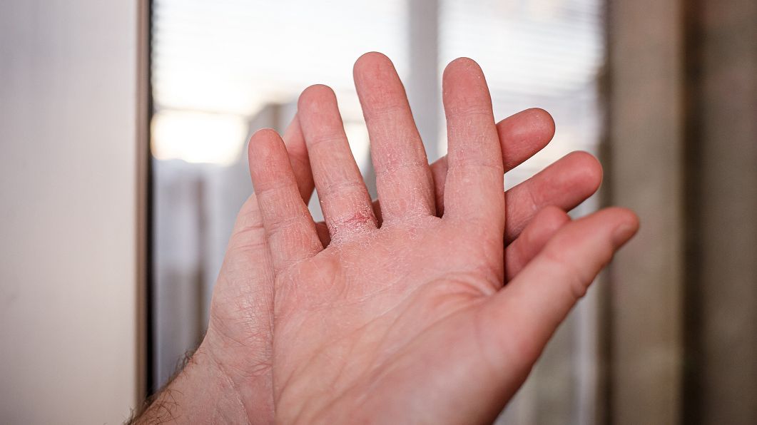 Drętwienie i mrowienie dłoni może mieć wiele przyczyn. Kiedy parestezje powinny zaniepokoić?