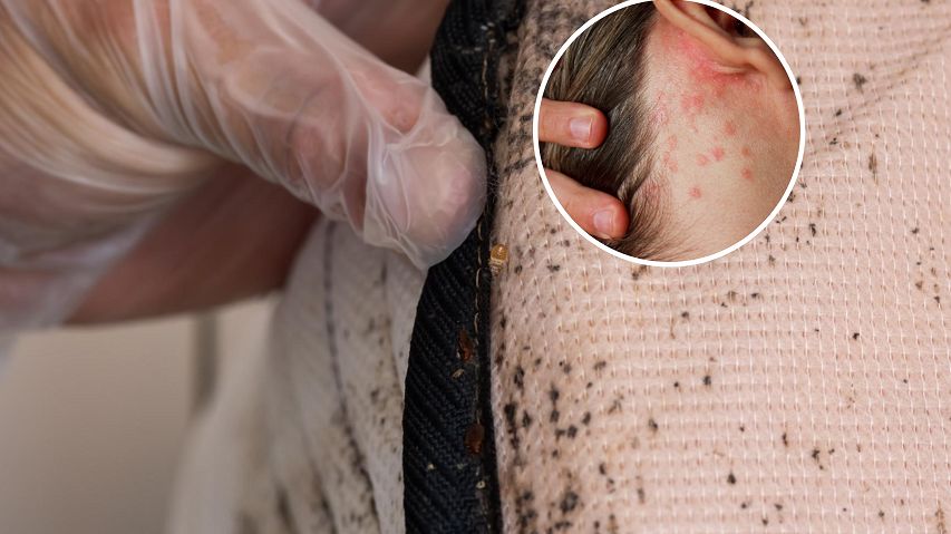 Jak poznać, że to ukąszenie pluskwy?