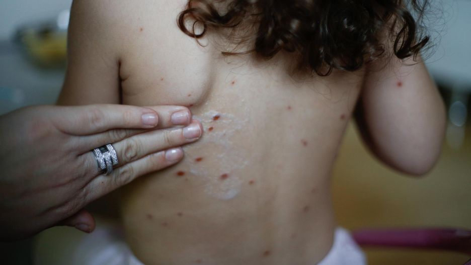 Dziecko zmarło z powodu powikłań odry. Tragiczny przypadek w USA