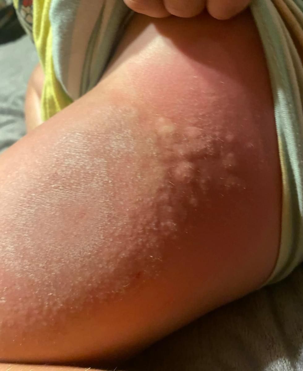 Wysypka na ciele sześciolatki