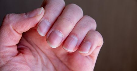 Pierwsze oznaki tych chorób widać na dłoniach. Lekarze mówią, co powinno nas zaniepokoić