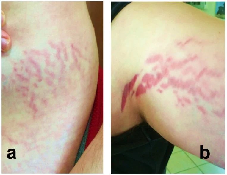 Choroba kociego pazura