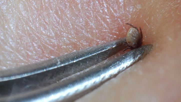 Urwany kleszcz. Co należy zrobić?