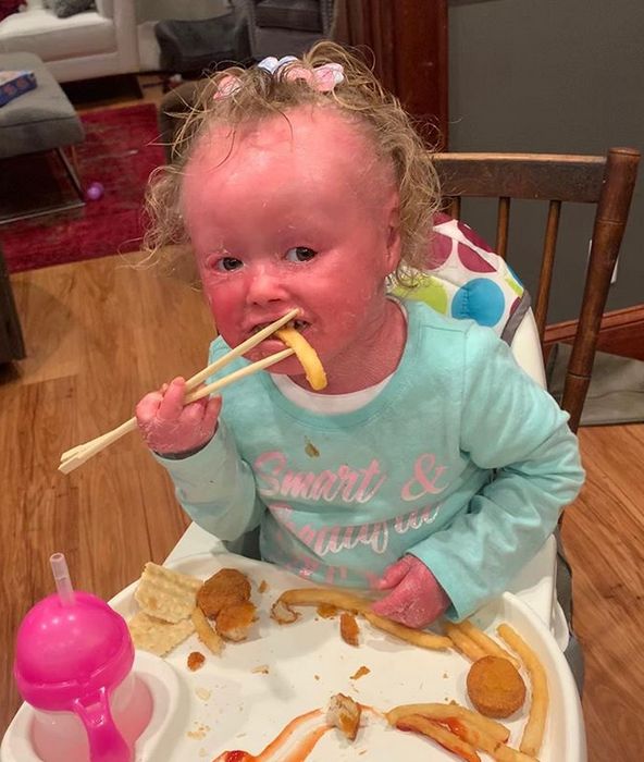 Dzisiaj dziewczynka rozwija się prawidłowo (Instagram/harlequindiva)