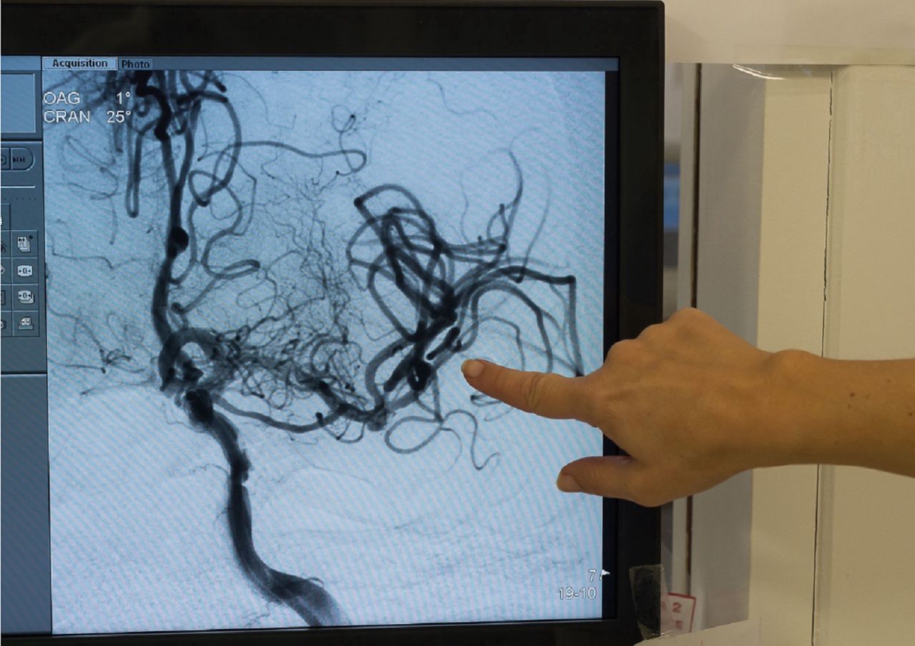 Udary po COVID-19. "U mnie na oddziale zmarło 40 proc. pacjentów"