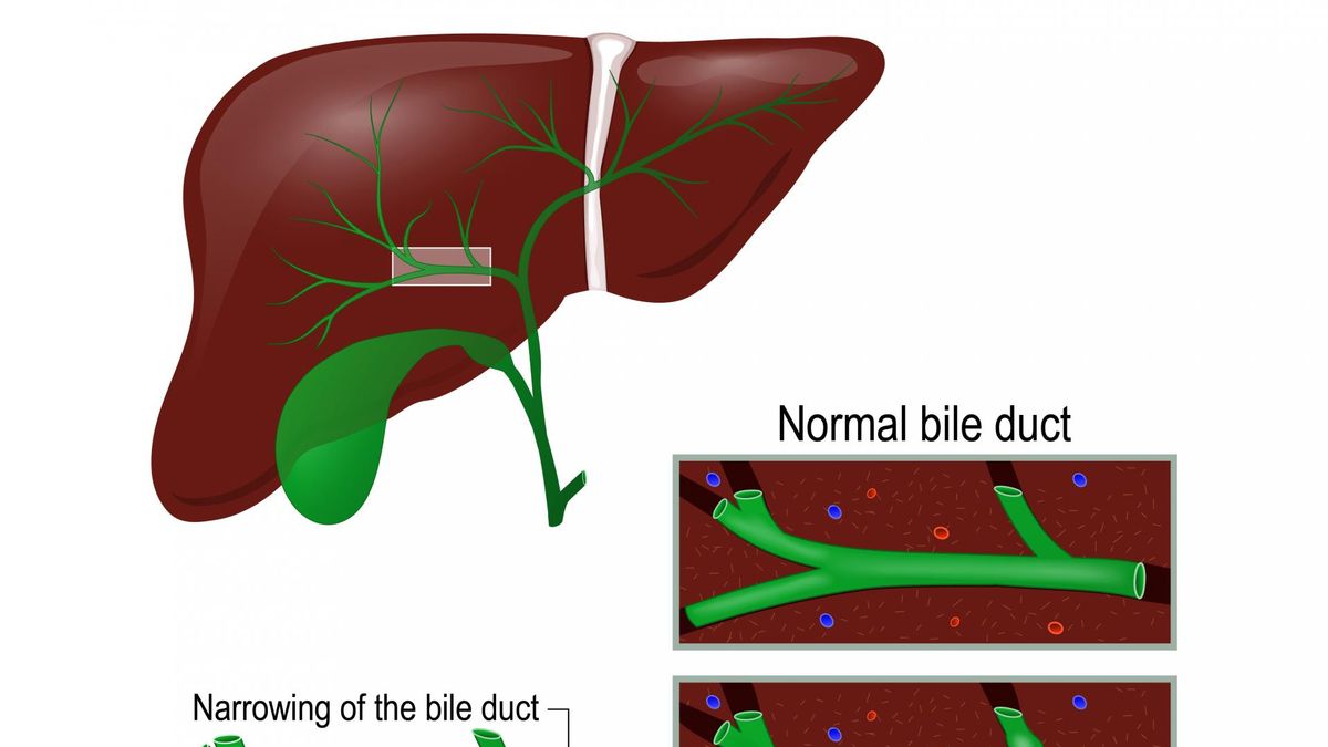Psc - stwardniające zapalenie dróg żółciowych.