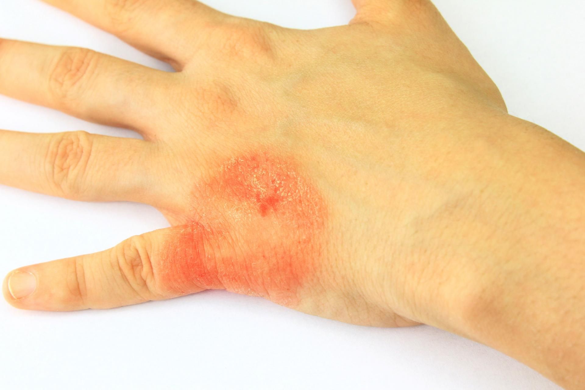 Grzybicą można się zarazić