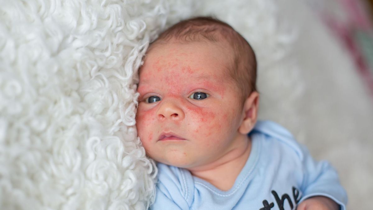Egzema u niemowląt może zająć okolice nosa, ust i uszu
