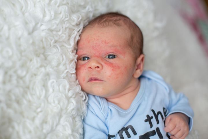 Egzema u niemowląt może zająć okolice nosa, ust i uszu