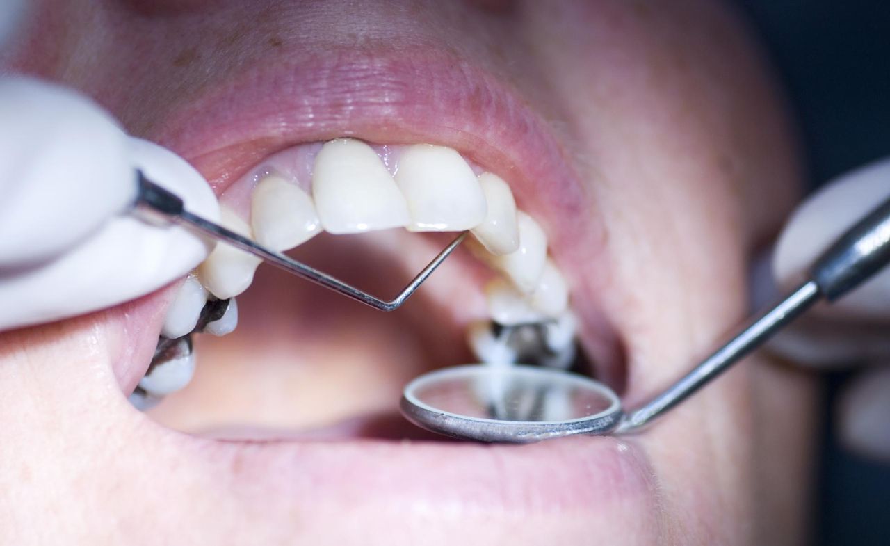 Amalgamat stomatologiczny a zdrowie. Toksyczny metal w zębach Polaków