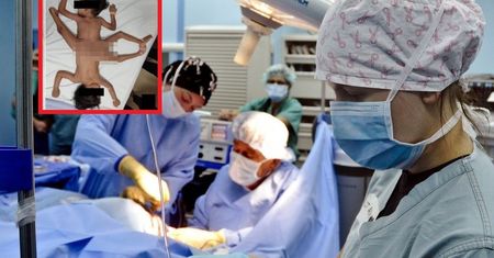 "Pajęcze" bliźnięta syjamskie. Zdarza się raz na 2 mln