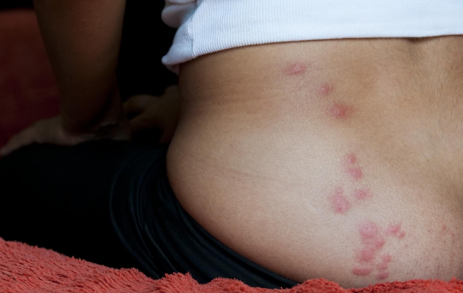 Liczne ślady na ciele świadczą o ukąszenia pluskiew