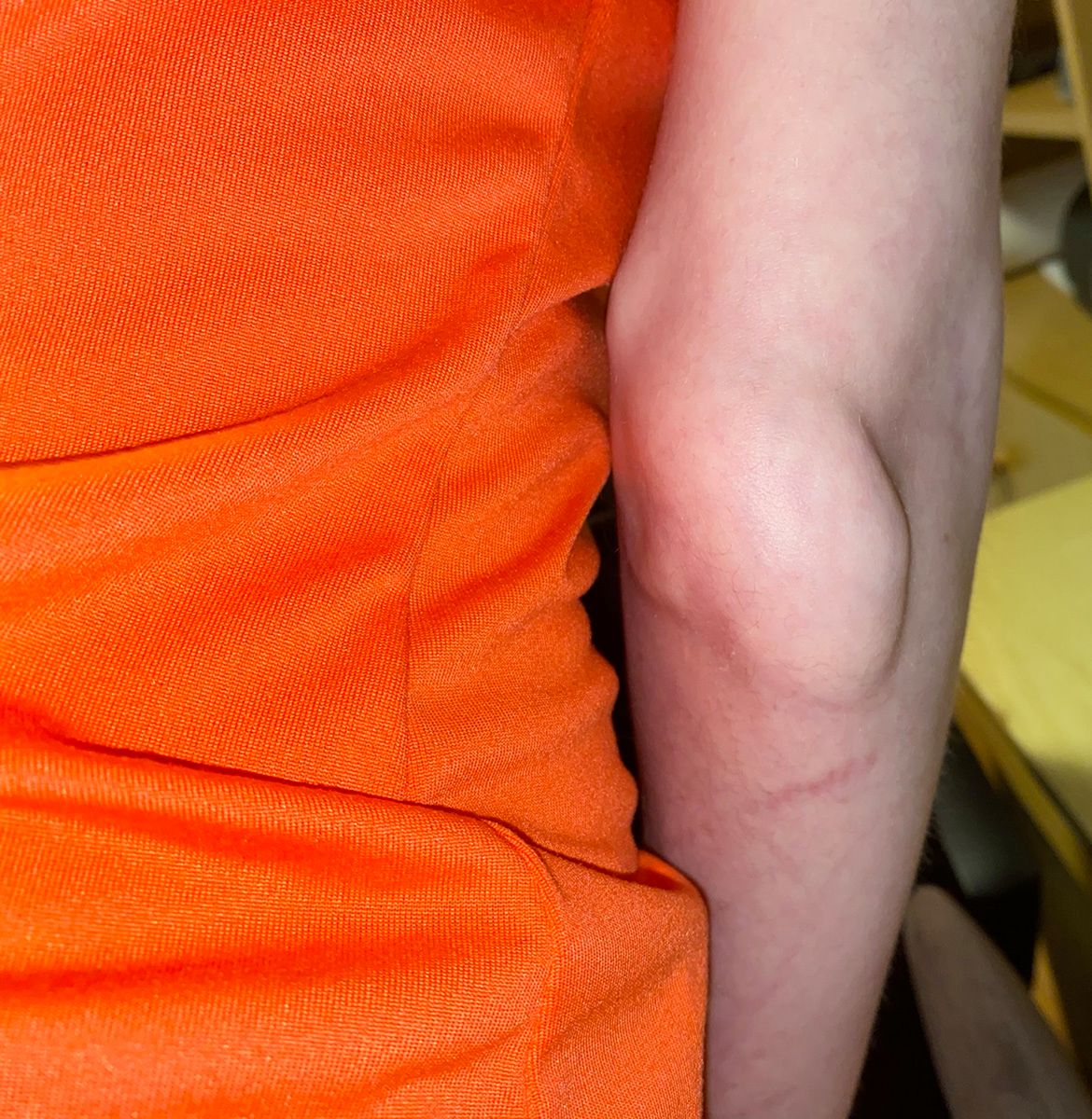 FOP sprawia, że mięsień zamienia się w kość