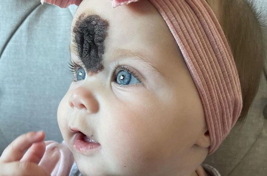 Vienna urodziła się z ogromnym znamieniem