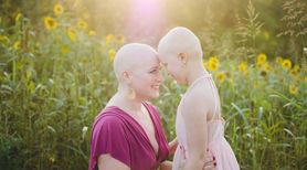 Wzruszająca sesja zdjęciowa mamy po chemioterapii i córki, chorującej na łysienie plackowate