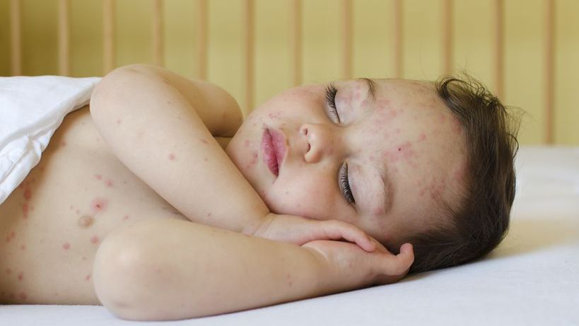 Brakuje szczepionek przeciwko ospie