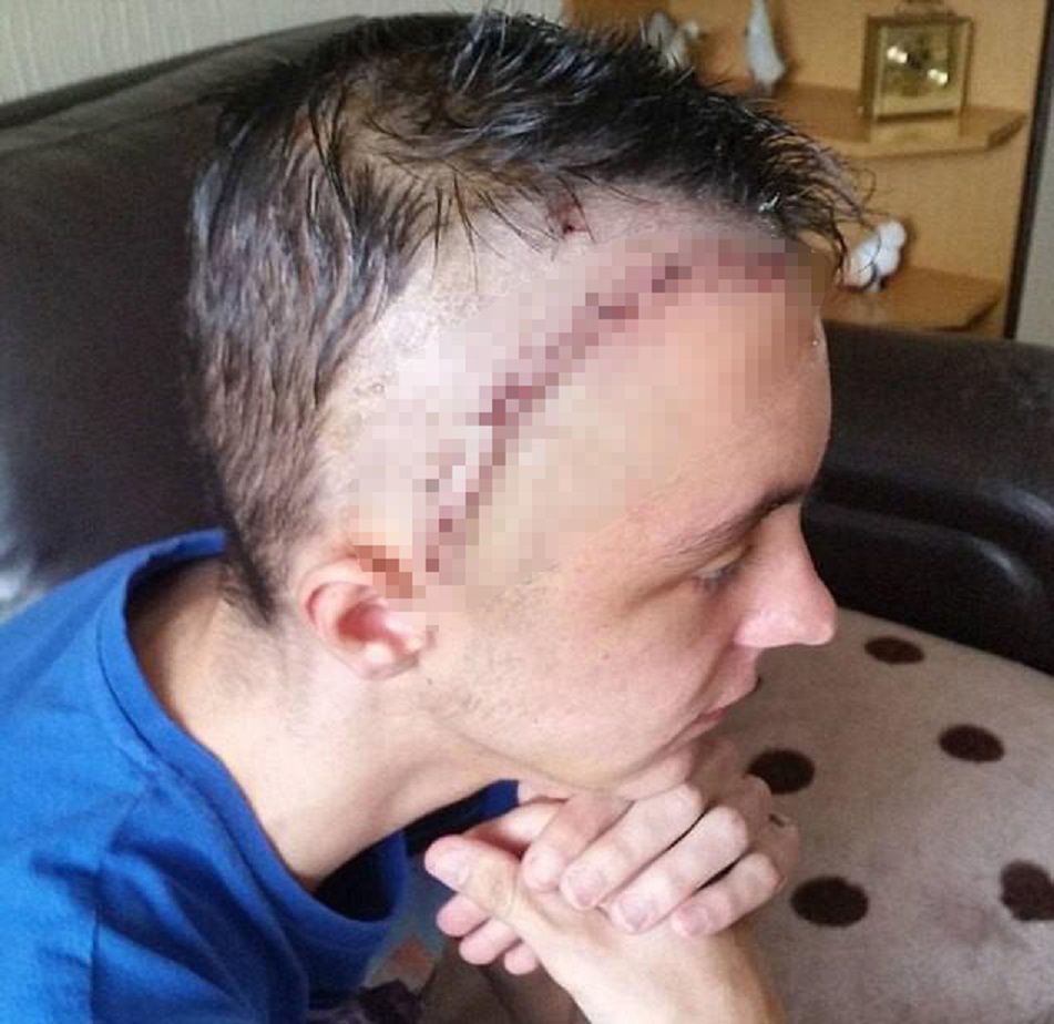 Skutki jazdy bez kasku mogą być jeszcze bardziej drastyczne