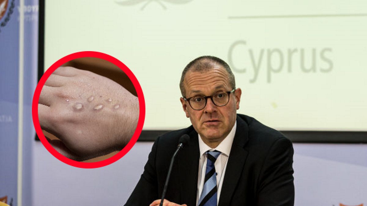 Nowy komunikat dotyczący małpiej ospy. WHO: Test dla Europy i świata