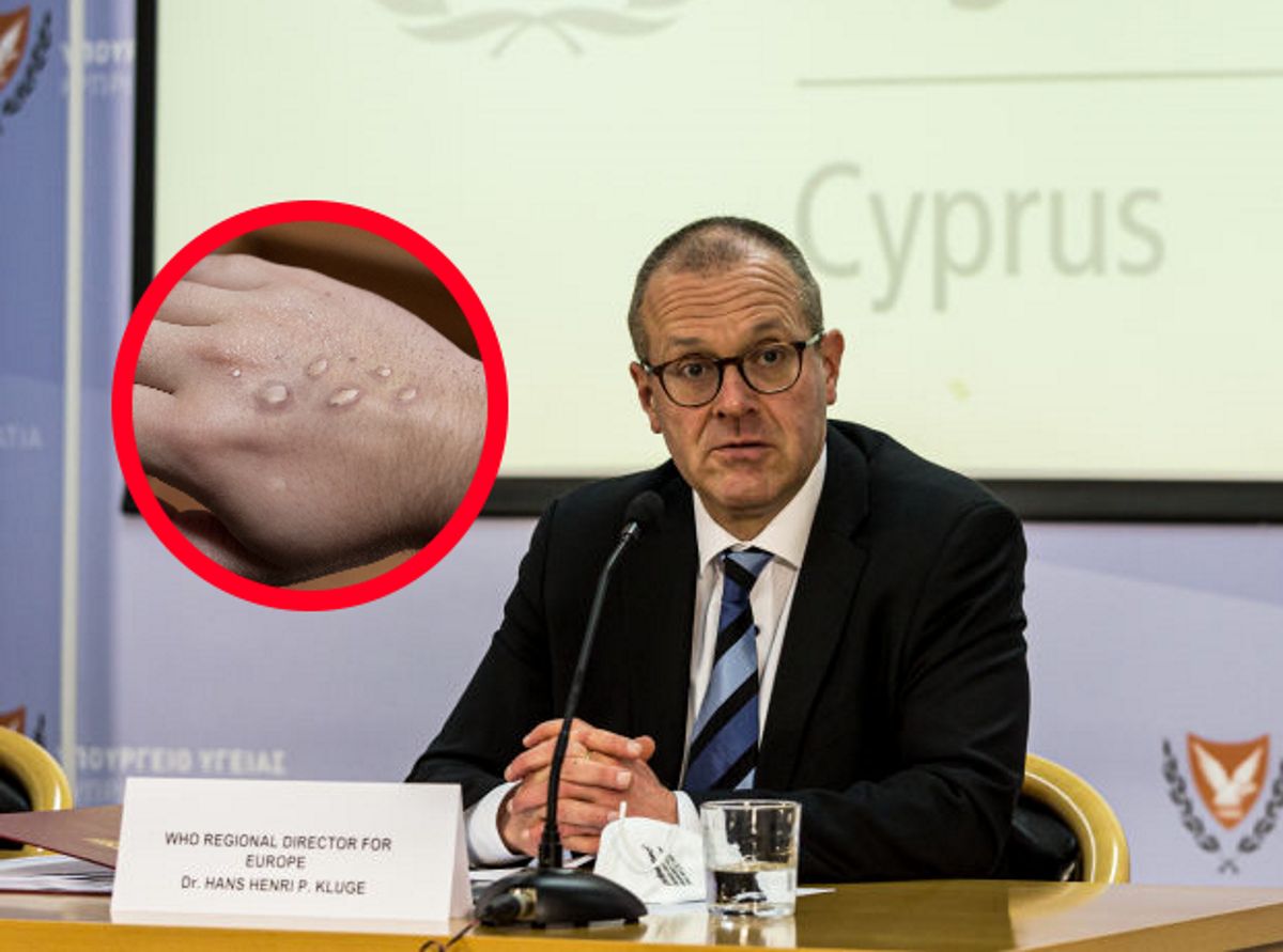 Małpia ospa budzi zaniepokojenie. WHO wydało nowy komunikat