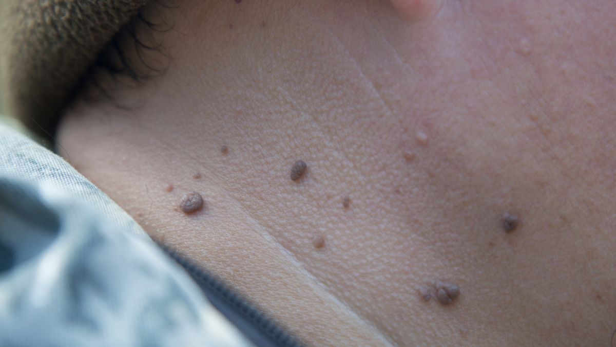 Brodawczaki na szyi to wymagające obserwacji zmiany skórne