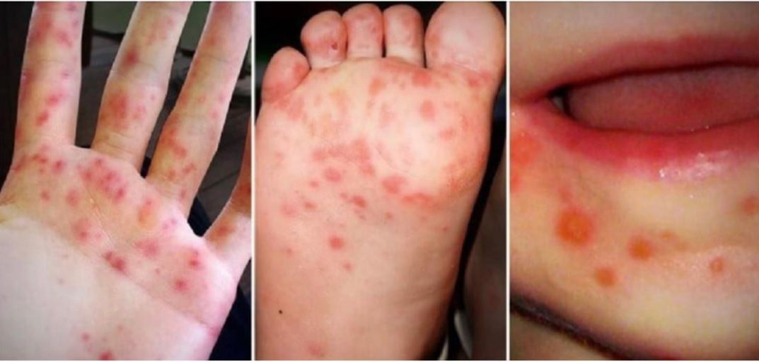 HMFS nazywana jest chorobą brudnych rąk ze względu na drogę przenoszenia