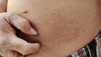 Widoczny objaw. Może zwiastować cukrzycę lub wysokie trójglicerydy