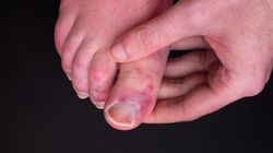 Nietypowe objawy long COVID. Zmiany mogą pojawić się na stopach