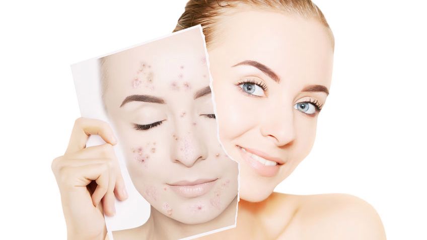 Acne-derm to popularny krem stosowany w leczeniu trądziku i przebarwień powstających z jego powodu.