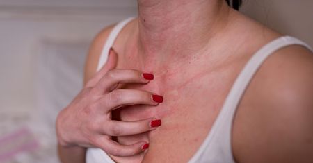 Lepiej zrezygnuj przed wyjściem na słońce. Objawy zauważysz na skórze