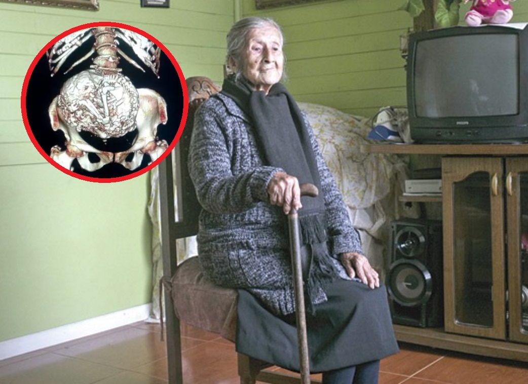 Lekarze nie mogli uwierzyć. 91-latka miała w brzuchu 60-letnie "dziecko"