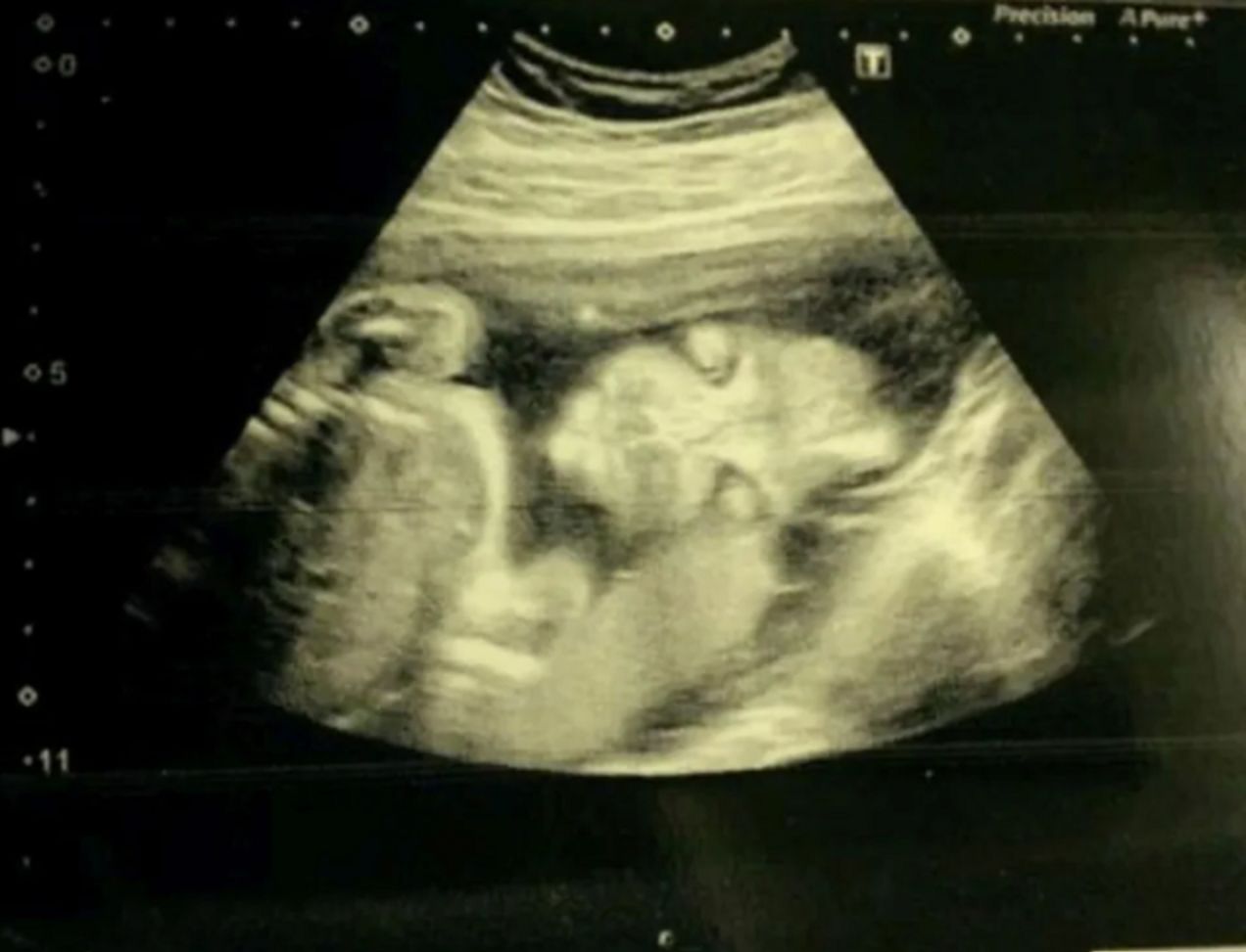 Przeraziła się podczas USG. Bała się, jak córka będzie wyglądała po urodzeniu